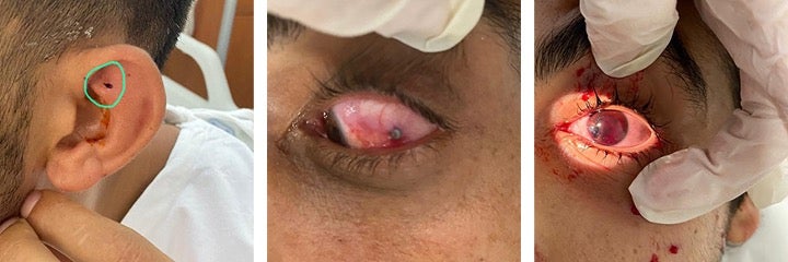 تسببت كريات الخردق المعدنية التي أطلقتها البنادق في إصابات في رؤوس وعيون المتظاهرين