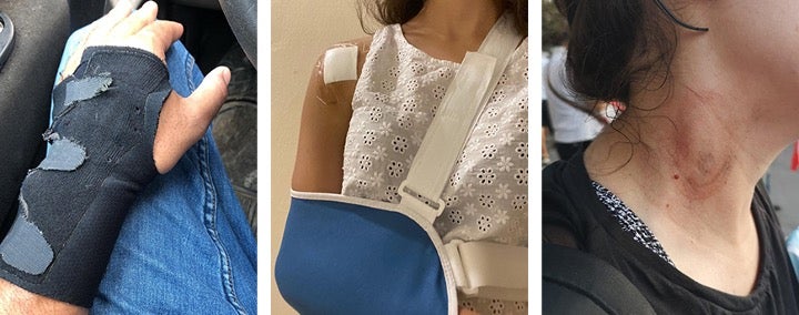 أصيب ثلاثة متظاهرين بقذائف الغاز المسيل للدموع التي أطلقت مباشرة على جذوعهم ورؤوسهم.