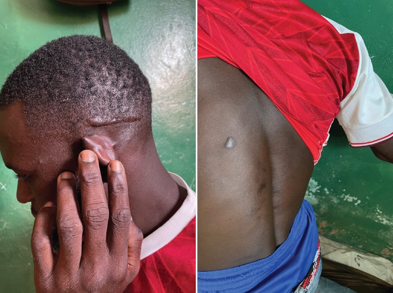 Side-by-side photos of a man showing scars on his head and back