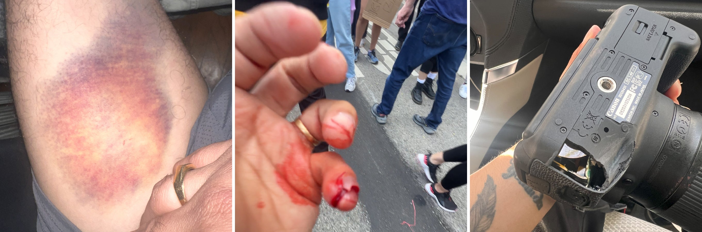 2 photos of close-up wounds on the leg and hand, one photo of a damaged camera