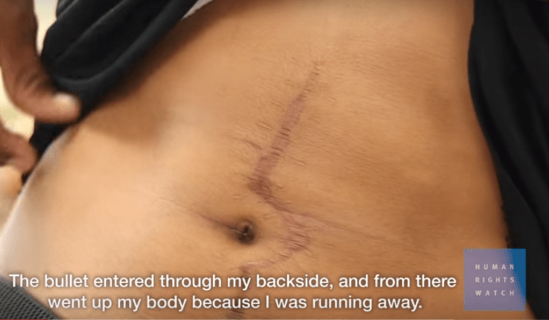 Rudy, a 16-year-old who was the victim of gang violence in El Salvador, shows a scar from the attack.