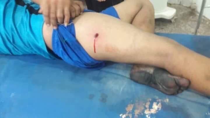 متظاهر يعرض جرح جراء طلق ناري في أعلى فخذه الأيمن. قال إن قوات الأمن العراقية أصابته خلال المظاهرات خارج حقل القرنة النفطي في 10 يوليو/تموز 2018. © 2018 خاص