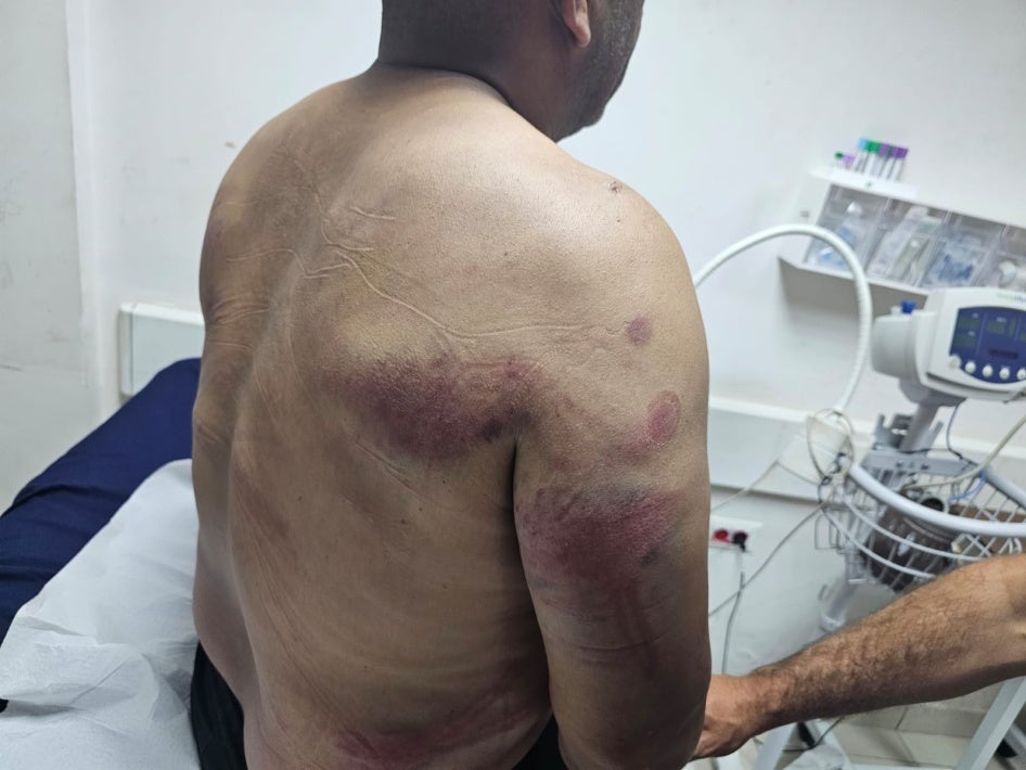 Bruising on one of the men attacked by settlers and active-duty soldiers, in Wadi al-Seeq on October 12, 2023. The man was hospitalized for his injuries.
