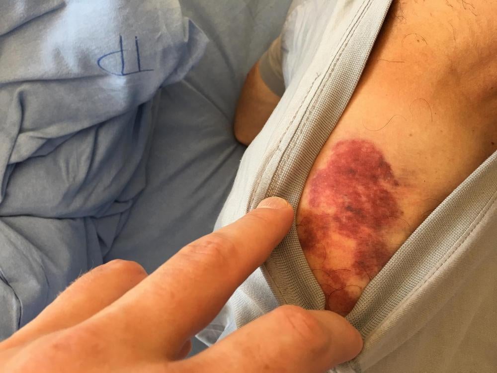 A bruise on the shoulder of Marut Vanyan, a cameraman with Lragir.am news site. Unidentified men cooperating with Armenian police beat Vanyan with wooden clubs as he filmed the police’s violent dispersal of protestors in the Erebuni district of Yerevan on