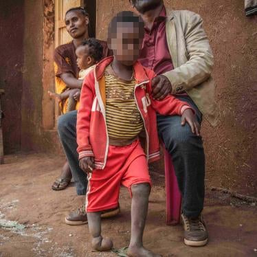 A 6-year-old boy, born near Lega Dembi gold mine in the Oromia region of Ethiopia, has no bones in his right foot and three toes on his left foot. 